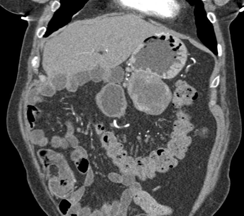 Gastric GIST Tumor Simulates a Pancreatic Mass - CTisus CT Scan