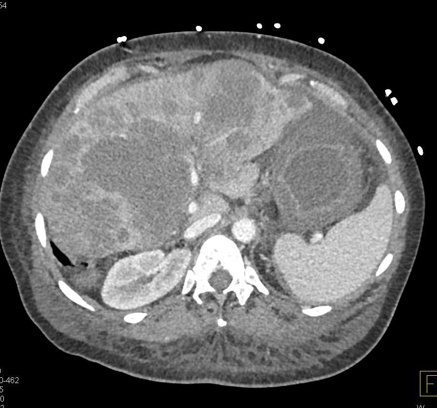 Gastric Cancer with Liver Metastases and Carcinomatosis - CTisus CT Scan