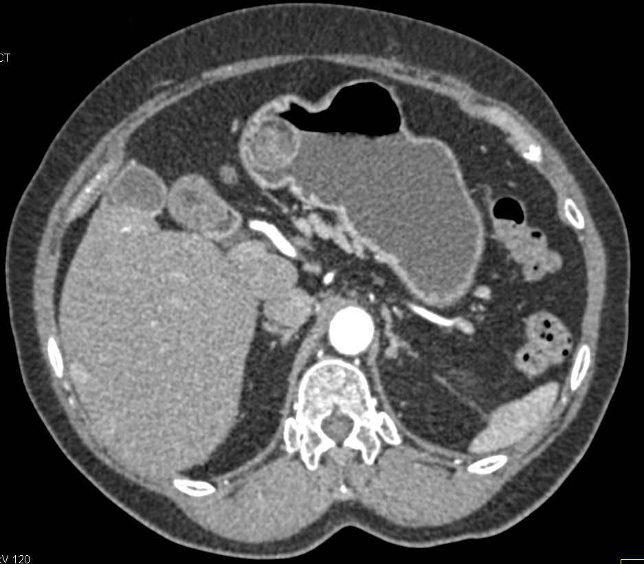Intraluminal GIST Tumor in the Stomach - CTisus CT Scan