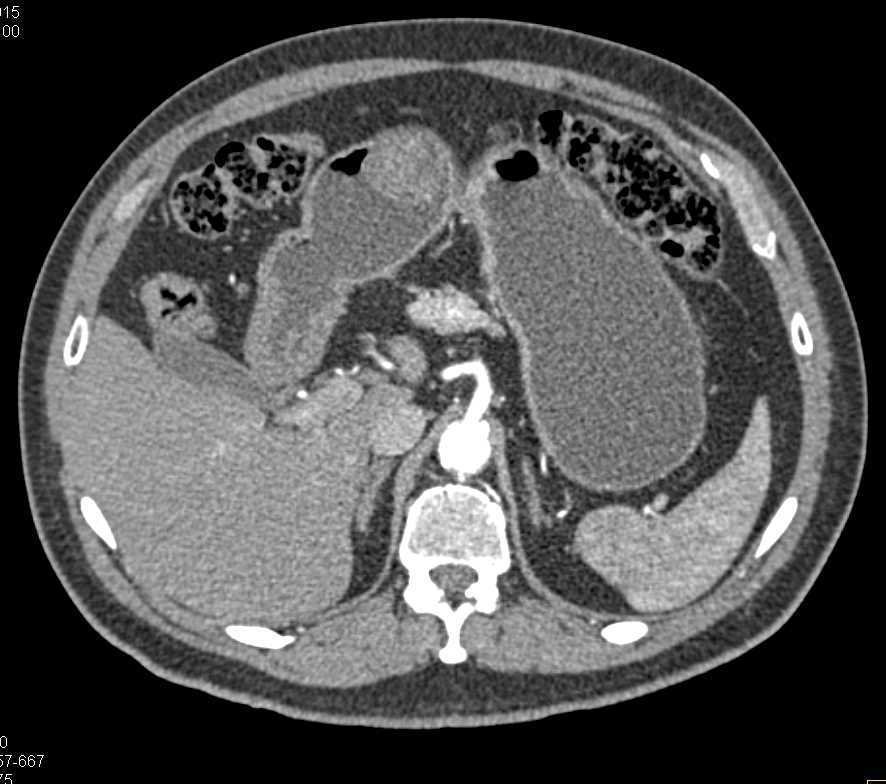 Intraluminal Gastric GIST Tumor - CTisus CT Scan
