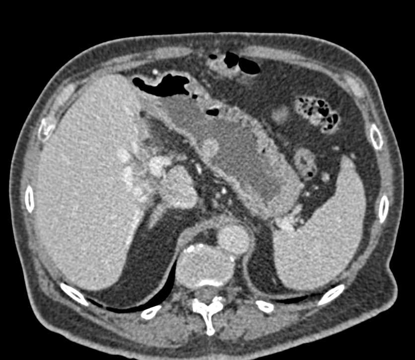 Gastric Carcinoid Tumor with Liver Metastases - CTisus CT Scan