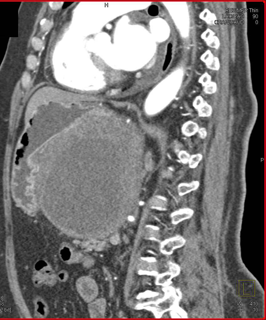 Ulcerating Gastric GIST Tumor - CTisus CT Scan