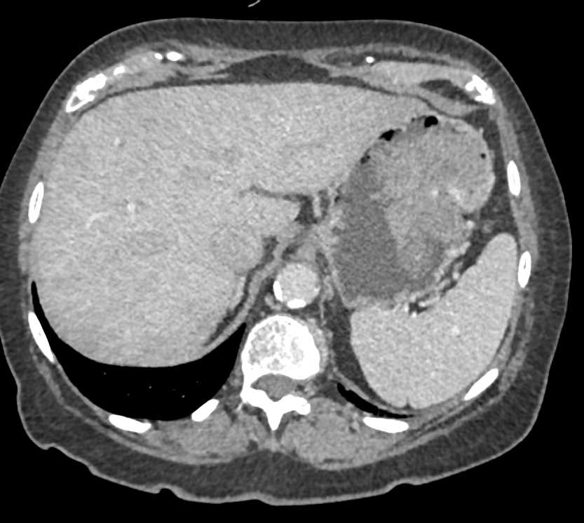 Active Bleeding from a Gastric GIST Tumor - CTisus CT Scan
