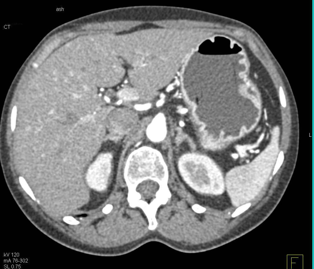 Subtle Gastric Adenocarcinoma Including 3D Imaging with VRT - CTisus CT Scan