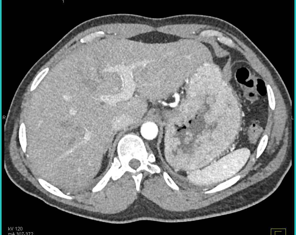 Menetrier's Disease with Thickened Gastric Folds in the Fundus of the Stomach - CTisus CT Scan