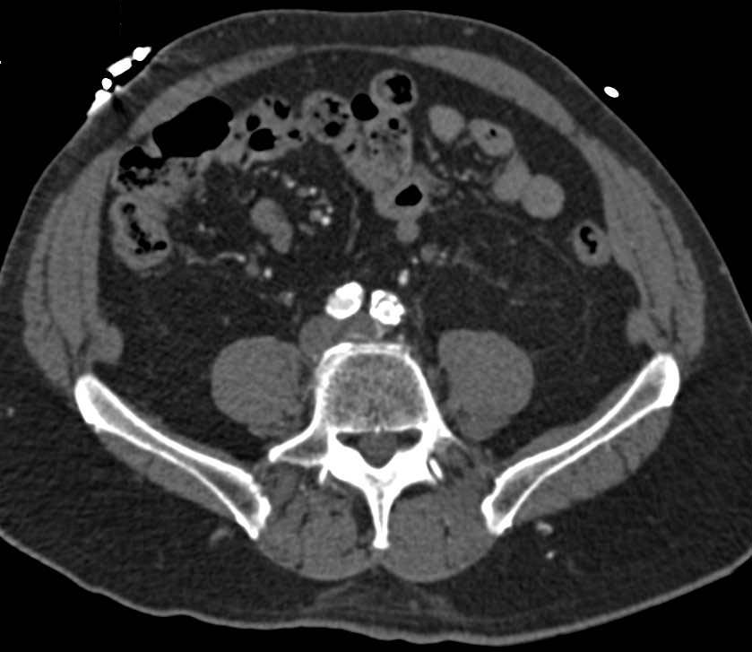 Gastric Polypoid Mass was an Adenocarcinoma - CTisus CT Scan