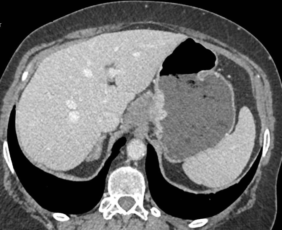 Carcinoma Gastroesophageal (GE) Junction Encases Celiac Artery - CTisus CT Scan