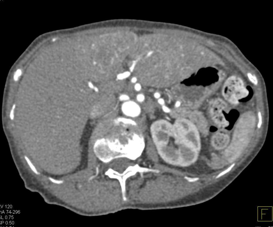 Zollinger-Ellison Syndrome with Thickened Gastric Folds and Liver Metastases - CTisus CT Scan