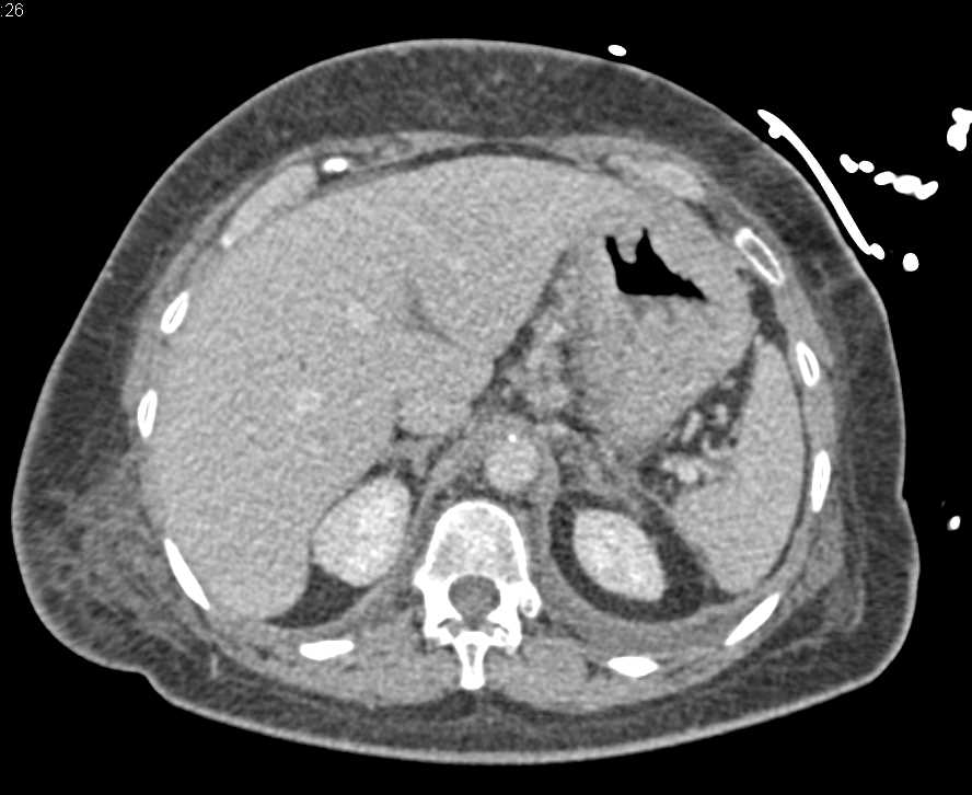 Gastric Adenocarcinoma - CTisus CT Scan