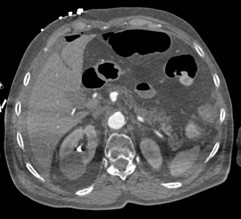 G-Tube Poorly Positioned Outside of the Stomach - CTisus CT Scan