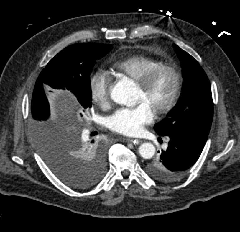 Perforated Antral Ulcer with Free Air - CTisus CT Scan