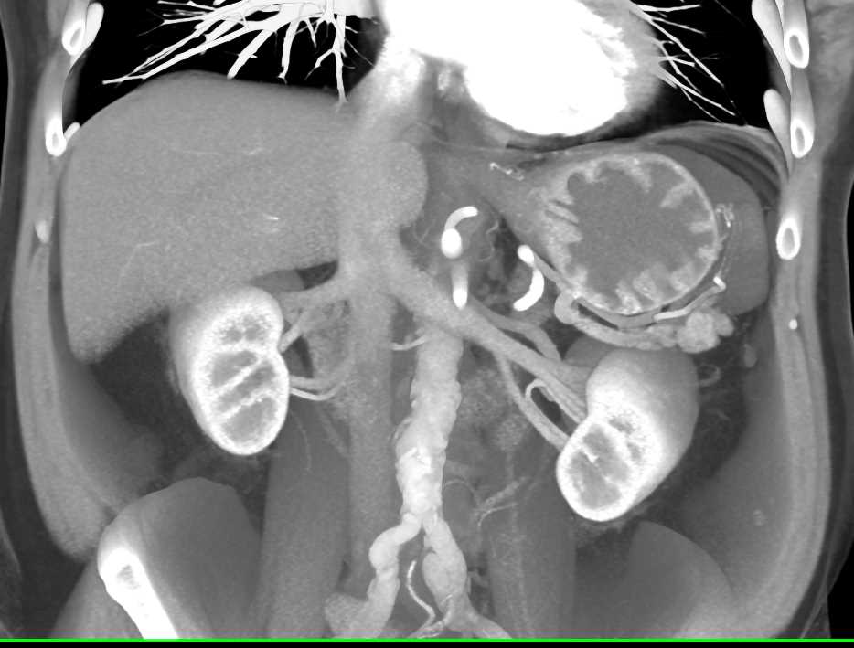 Gastritis with Thickened Gastric Folds - CTisus CT Scan