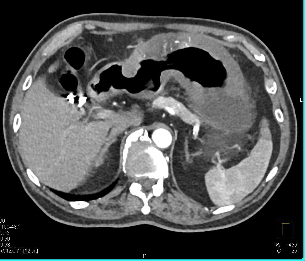 Infiltrating Gastric Adenocarcinoma - CTisus CT Scan