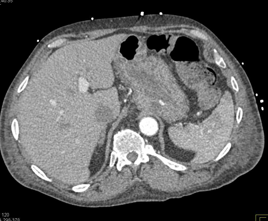 Subtle Focus of Active Bleeding in the Stomach - CTisus CT Scan