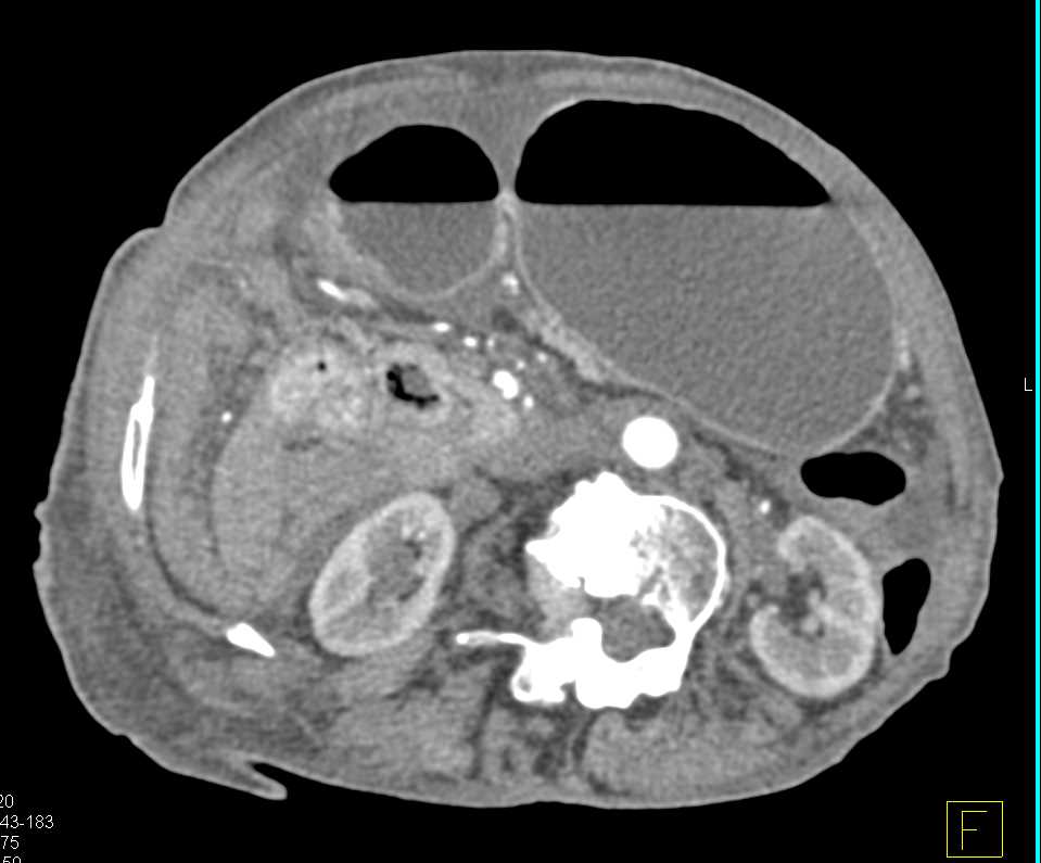 Duodenal Carcinoma with Ulcer Obstructs the Stomach - CTisus CT Scan