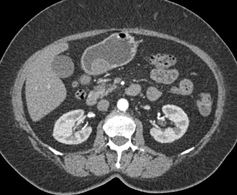 GIST Tumor Gastric Antrum - CTisus CT Scan