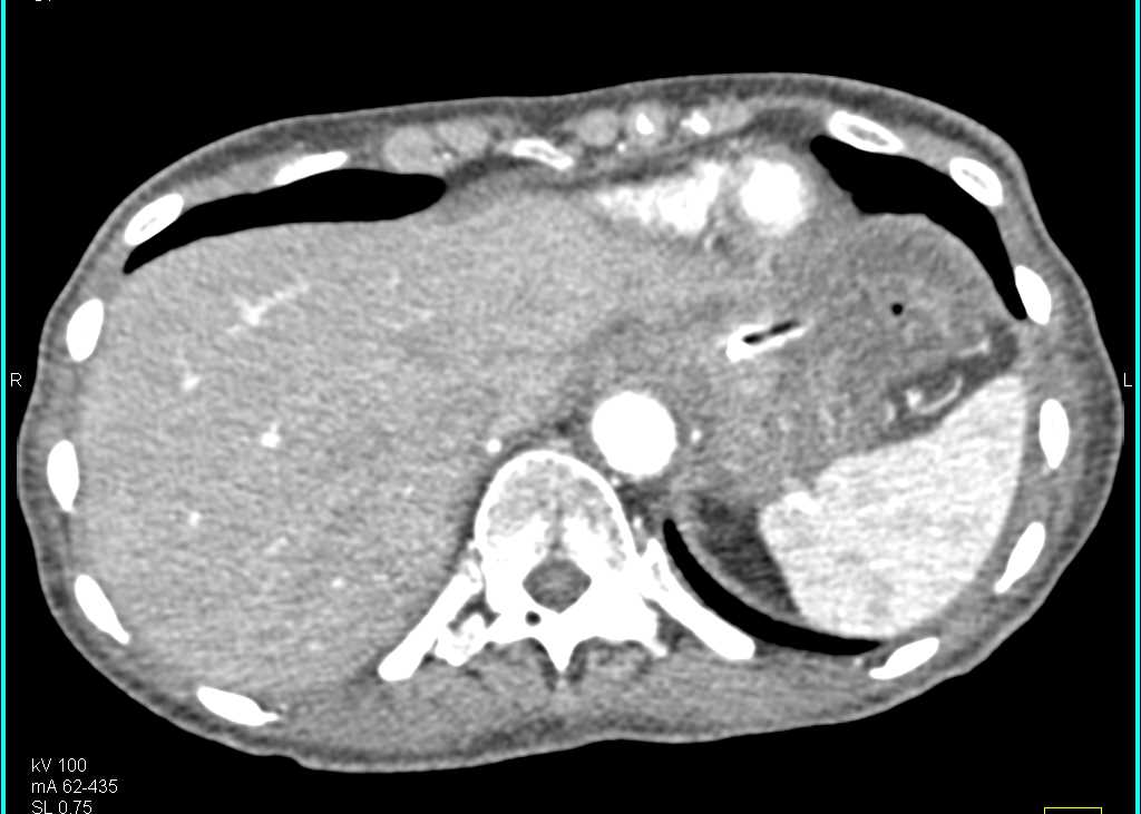 Bulky Gastric Adenocarcinoma with Extensive Adenopathy - CTisus CT Scan