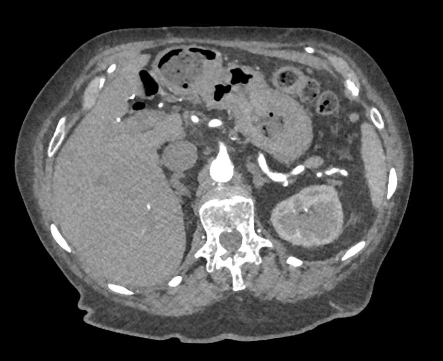 Gastric Adenocarcinoma with Ulcerations - CTisus CT Scan