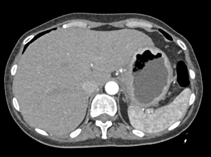 Linitis Plastica of the Stomach - CTisus CT Scan
