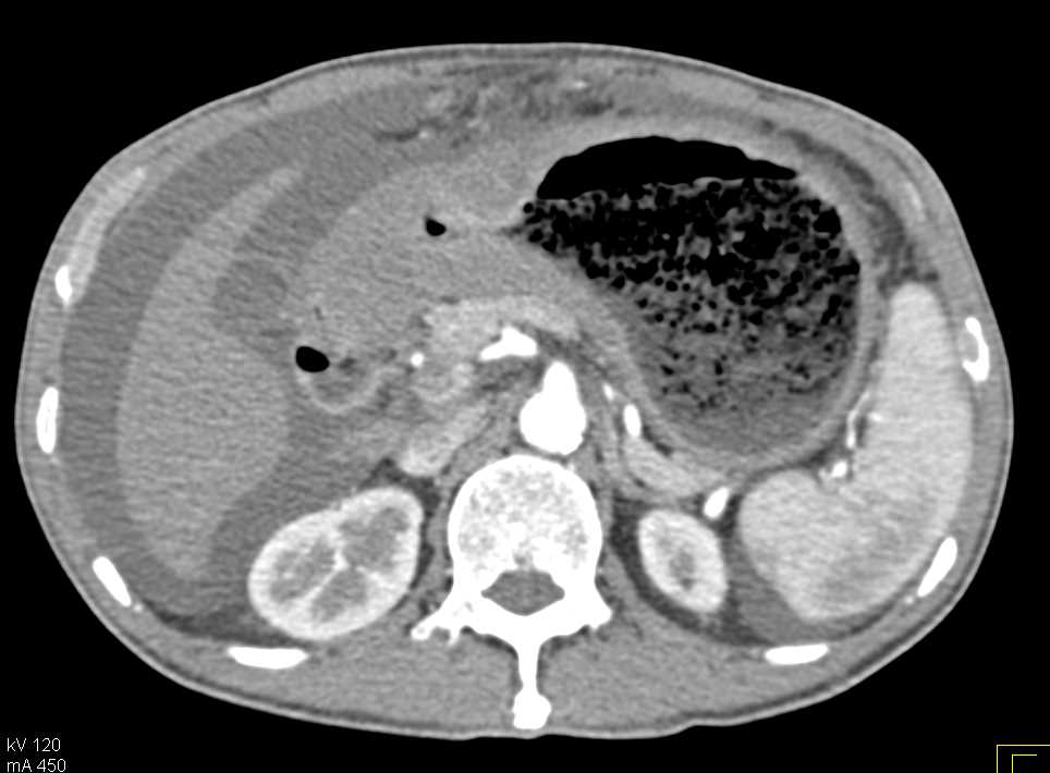 Infiltrating Gastric Adenocarcinoma in the Antrum with Carcinomatosis - CTisus CT Scan