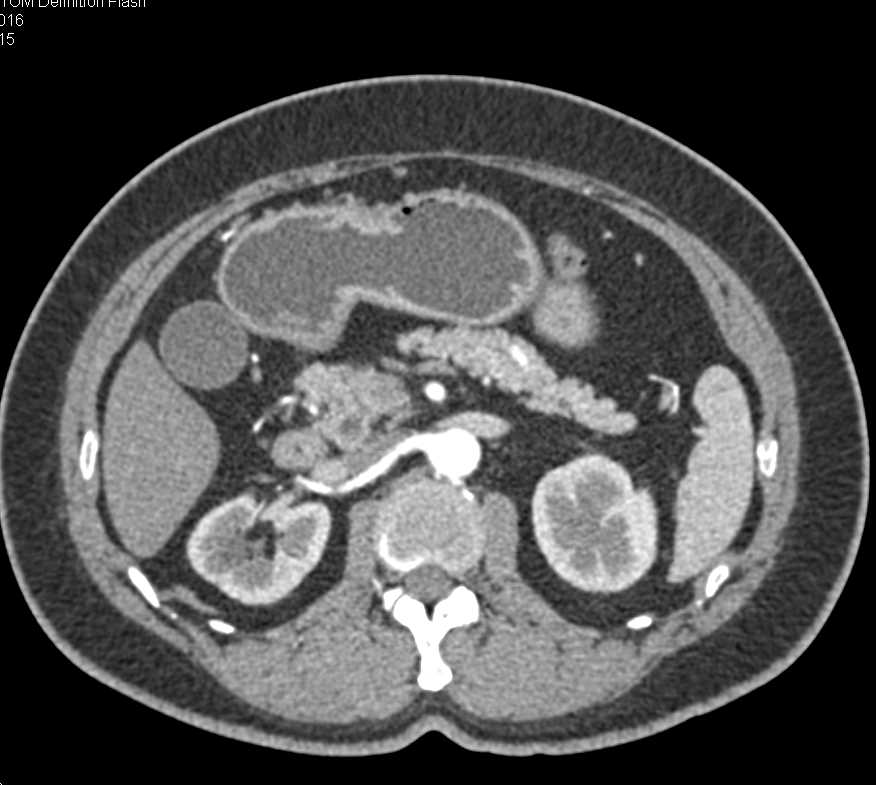 Antral Thickening and Inflammation - CTisus CT Scan