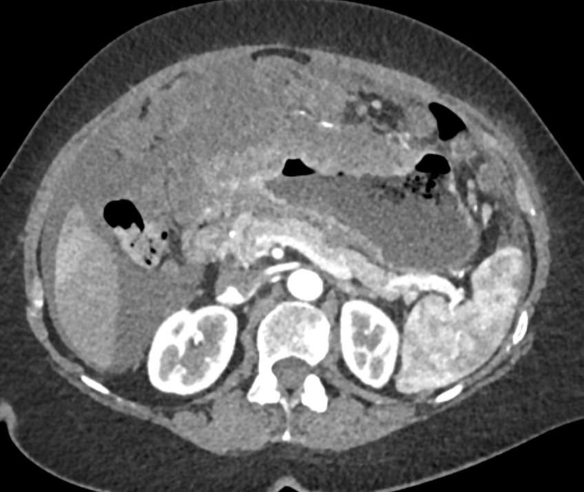 Gastric Adenocarcinoma with Carcinomatosis - CTisus CT Scan