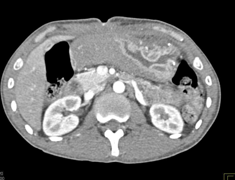 Lymphoma Infiltrating the Body and Antrum of the Stomach - CTisus CT Scan