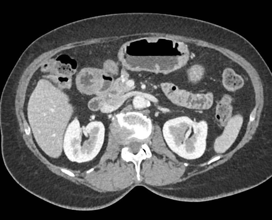 Infiltrating Gastric Cancer - CTisus CT Scan