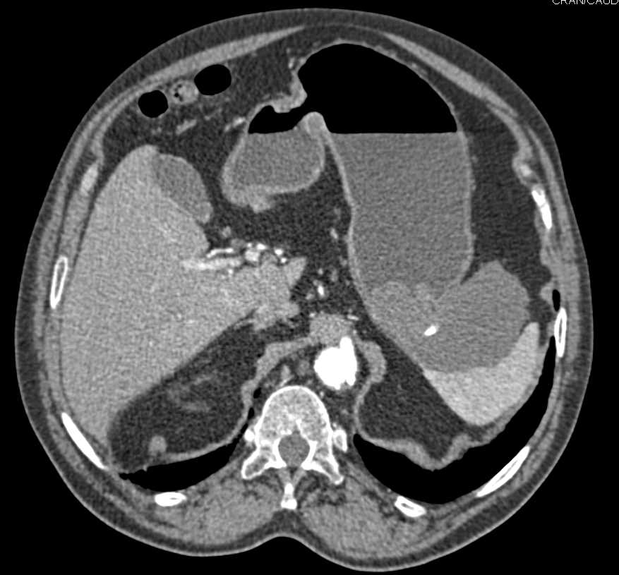Gastric GIST Tumor Extends to the Spleen - CTisus CT Scan