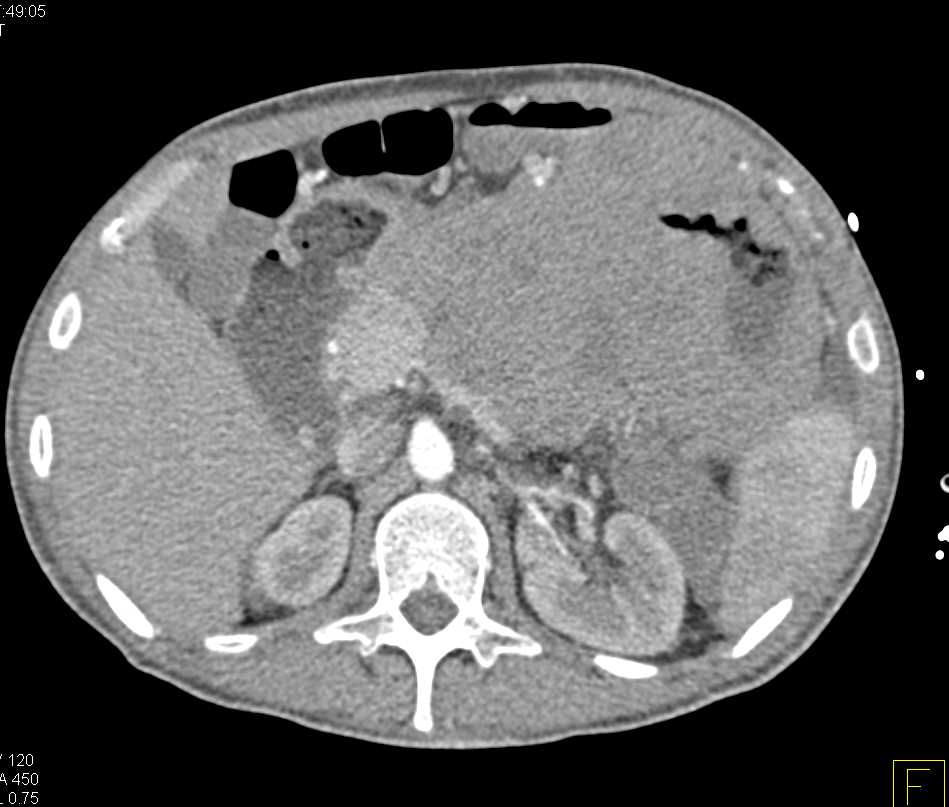 Ulcerating Gastric GIST Tumor - CTisus CT Scan