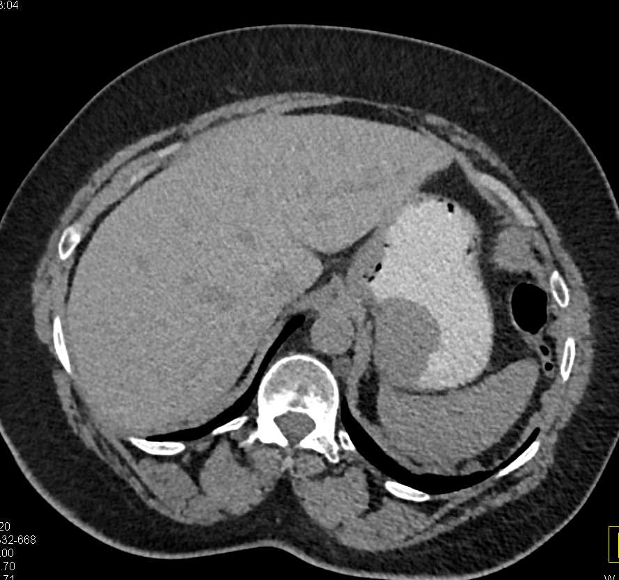 Gastric GIST Tumor - CTisus CT Scan