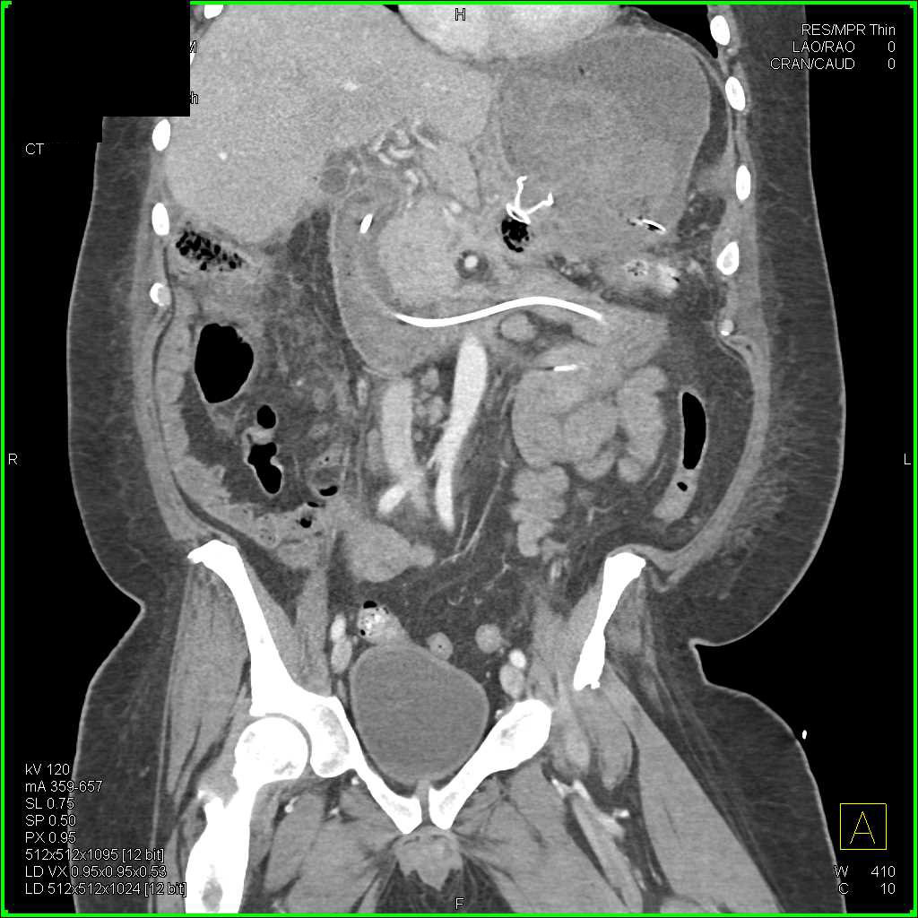 Hemorrhage in the Stomach in Patient with Pancreatic Necrosis - CTisus CT Scan