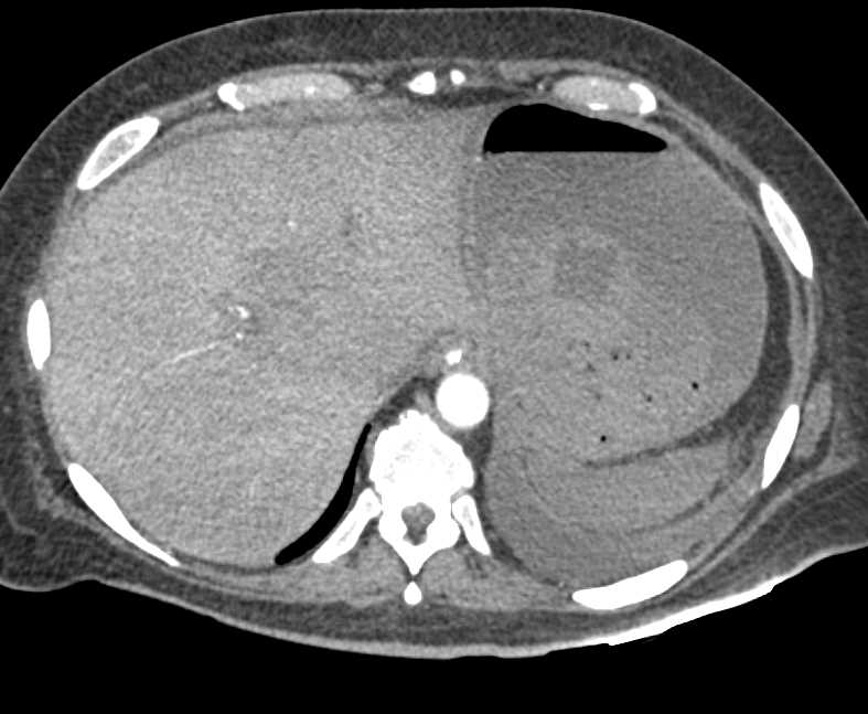 Hemorrhage in the Stomach in Patient with Pancreatic Necrosis and Bright Adrenal Glands - CTisus CT Scan
