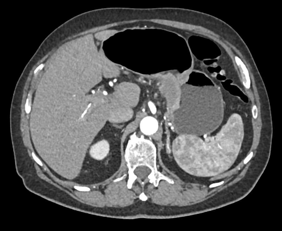 Gastric Adenocarcinoma in the Body of the Stomach - CTisus CT Scan