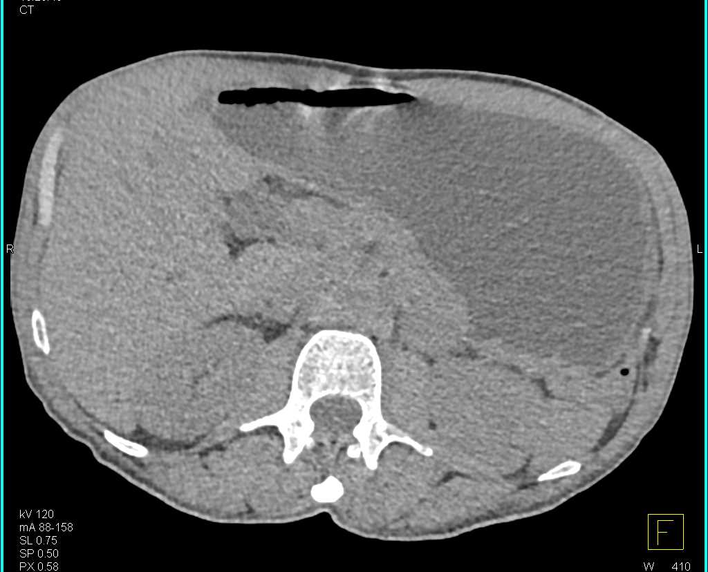 Obstructed Stomach due to channel Ulcer - CTisus CT Scan