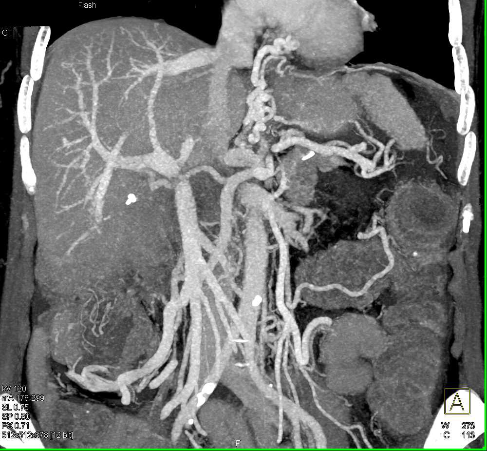 Gastric Varices - CTisus CT Scan