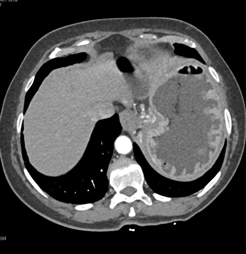Multiple Fundal Polyps - CTisus CT Scan