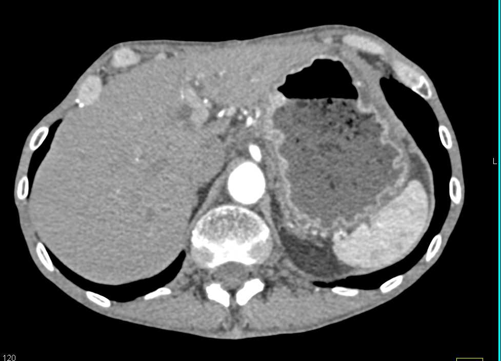 Infiltrating Gastric Adenocarcinoma with Carcinomatosis - CTisus CT Scan