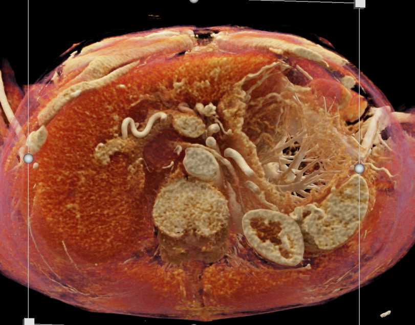 Infiltrating Gastric Adenocarcinoma with Carcinomatosis with Cinematic Rendering - CTisus CT Scan
