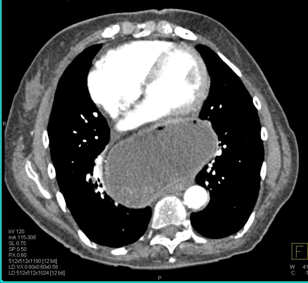 Gastric Volvulus - CTisus CT Scan