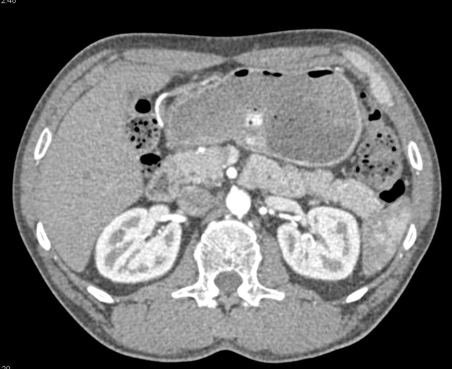 Bleeding Gastric Ulcer on CTA - CTisus CT Scan