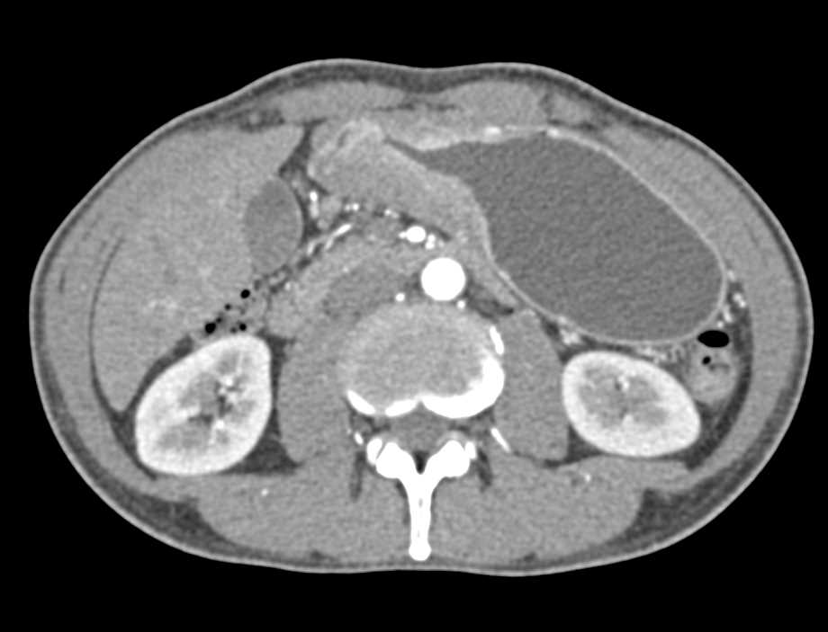 Gastric Adenocarcinoma - CTisus CT Scan