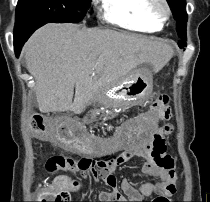 Infiltrating Gastric Adenocarcinoma Excludes Down to the Transverse Colon - CTisus CT Scan