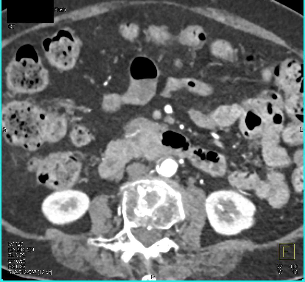 Gastric GIST Tumor - CTisus CT Scan