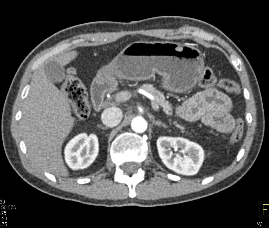 Benign Gastric Polyp - CTisus CT Scan