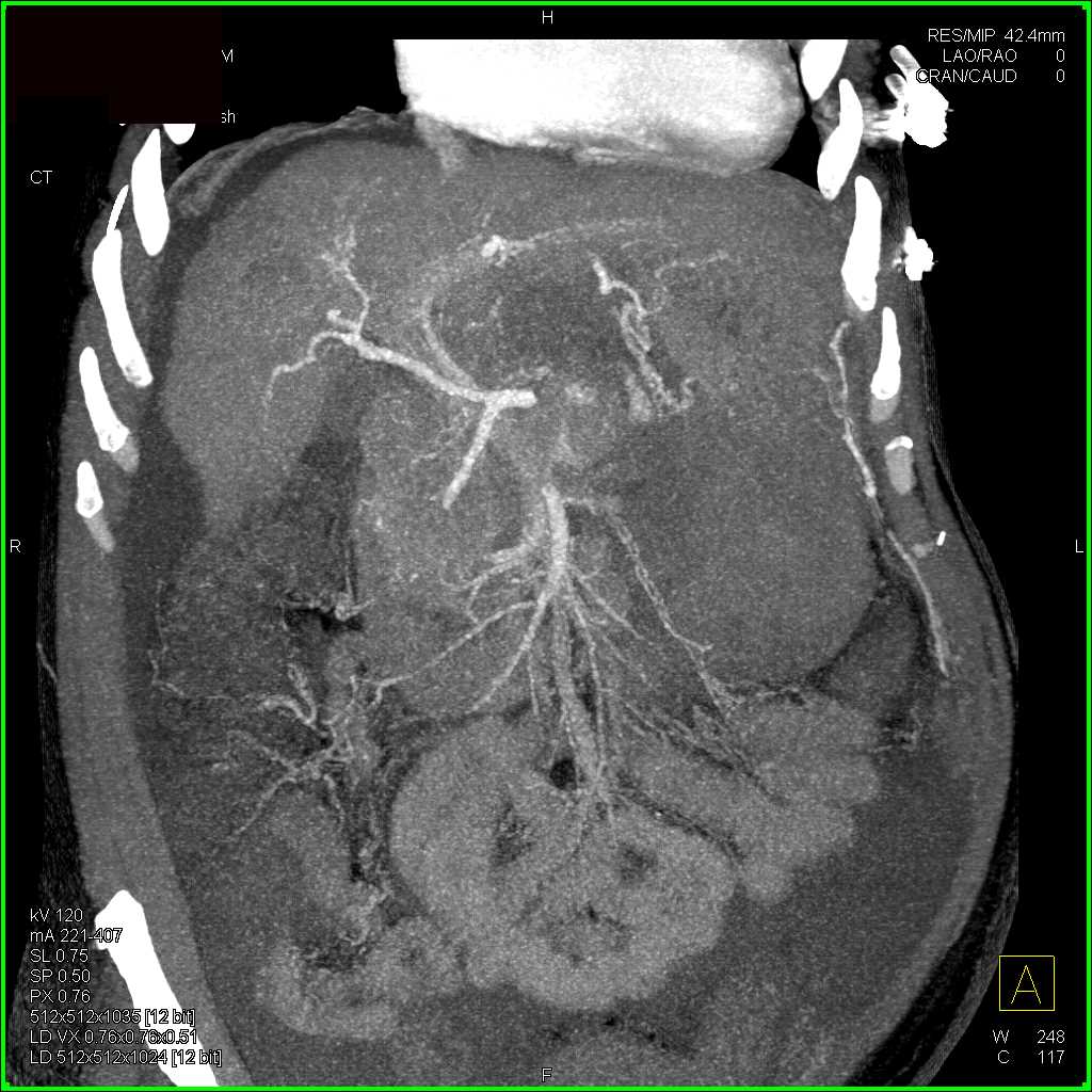 Gastric Bleed in Cirrhotic Patient - CTisus CT Scan