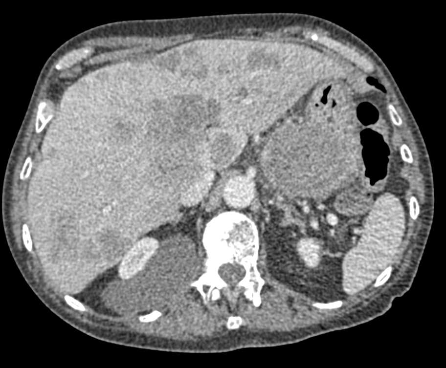 Gastric GIST Tumor with Liver and Bone Metastases - CTisus CT Scan