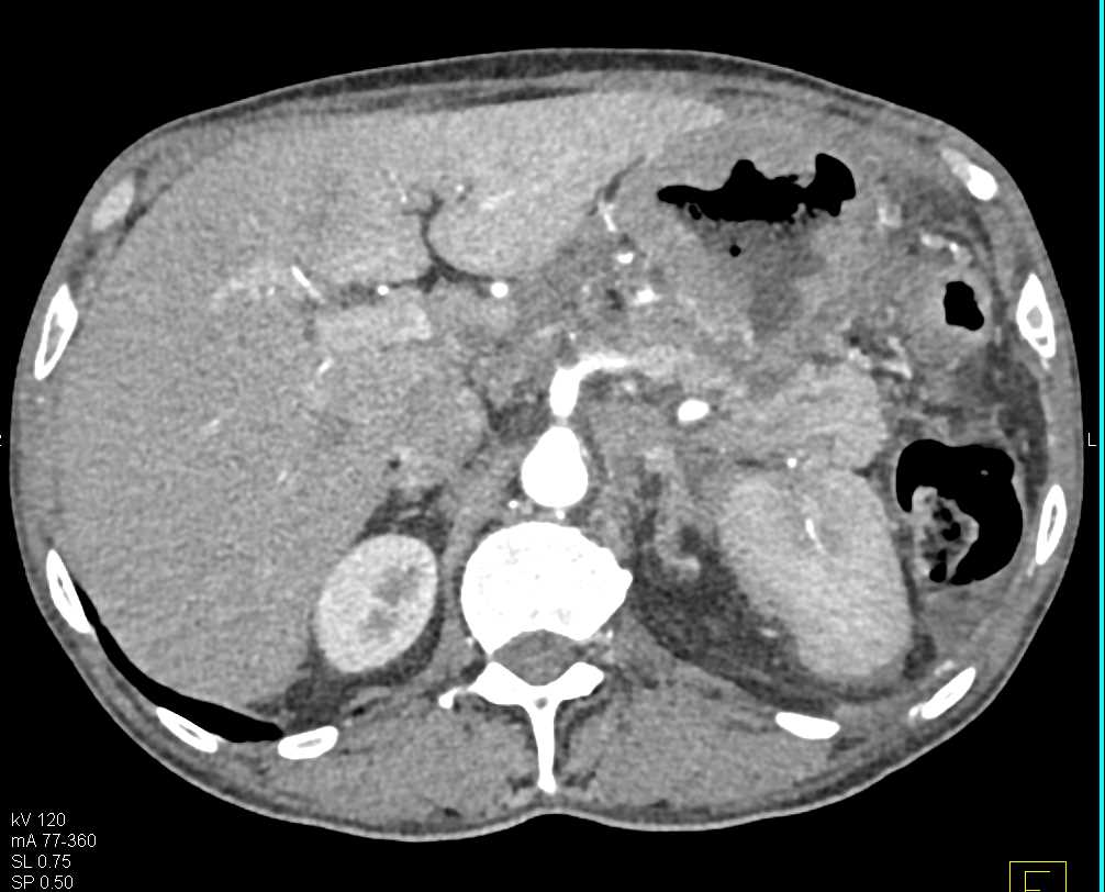 Gastric Adenocarcinoma with Carcinomatosis - CTisus CT Scan