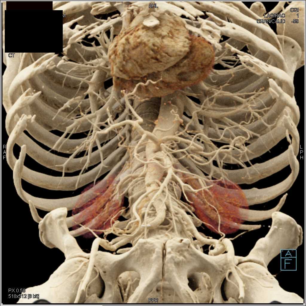 Gastric Adenocarcinoma - CTisus CT Scan
