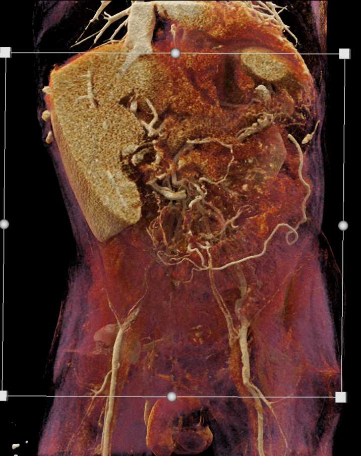 Gastric Adenocarcinoma - CTisus CT Scan